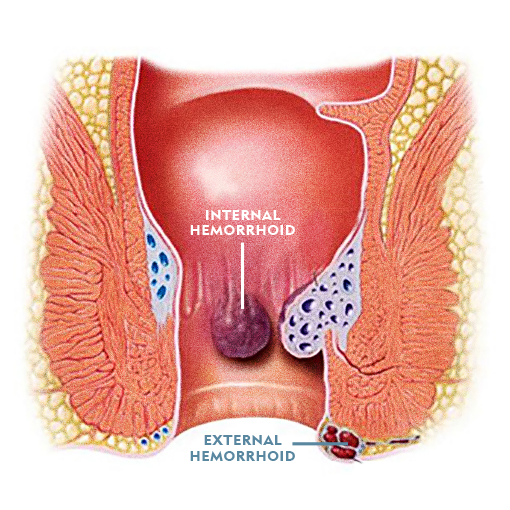 Hemorrhoid Treatment Center of Orange County 6 Diagram of Internal Hemorrhoid