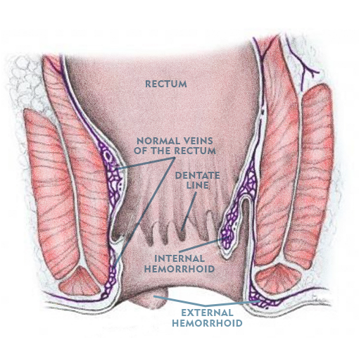 Hemorrhoid Treatment Center of Orange County 5 Diagram of External Hemorrhoid